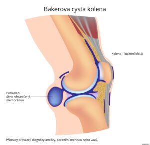 bakerova-cysta-1